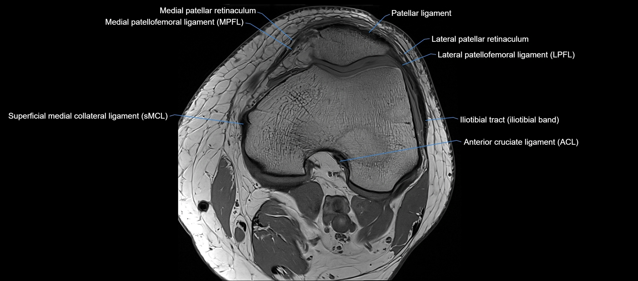 MRI Knee axial  ligaments cross sectional anatomy 3T  radiology  image-img-03001-00018.webp